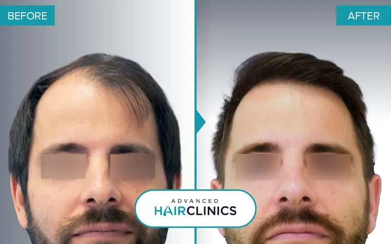 Before and after an FUE hair transplant with 4,267 grafts